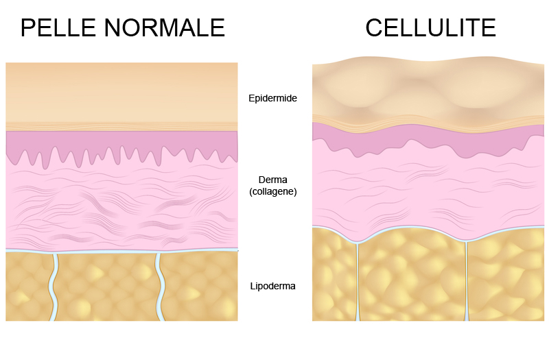 Schema di differenza tra pelle normale e cellulite nei 3 strati della pelle